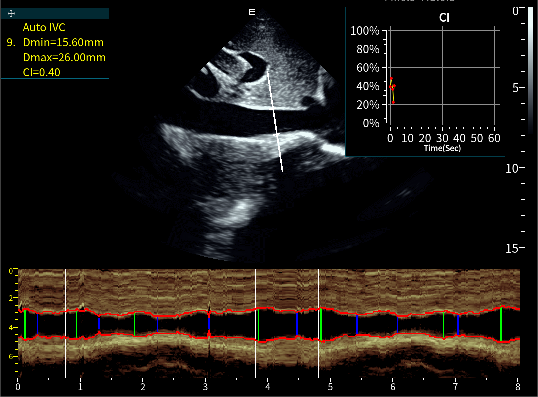 Auto IVC下腔静脉自动测量