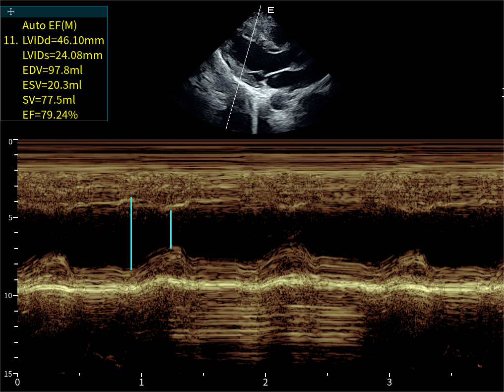 Auto EF(M)射血分数自动测量
