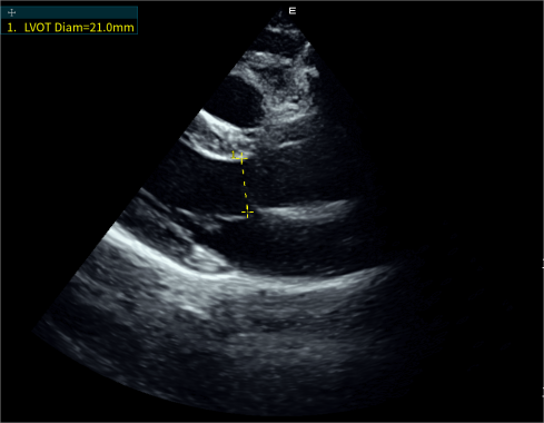 Auto LVOT-D左室流出道直径自动测量